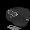 SPORK, NICO - 22.03.1976 - 02.08.2022 - CT obere Extremität - 17:51:17